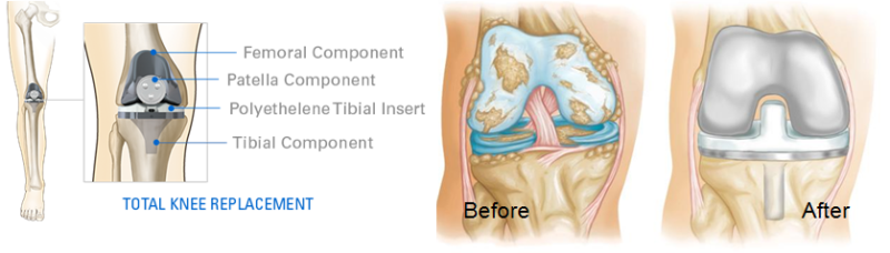Knee replacement surgery Bangalore